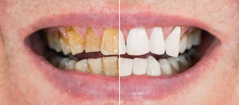 Beljenje zuba - pre i posle